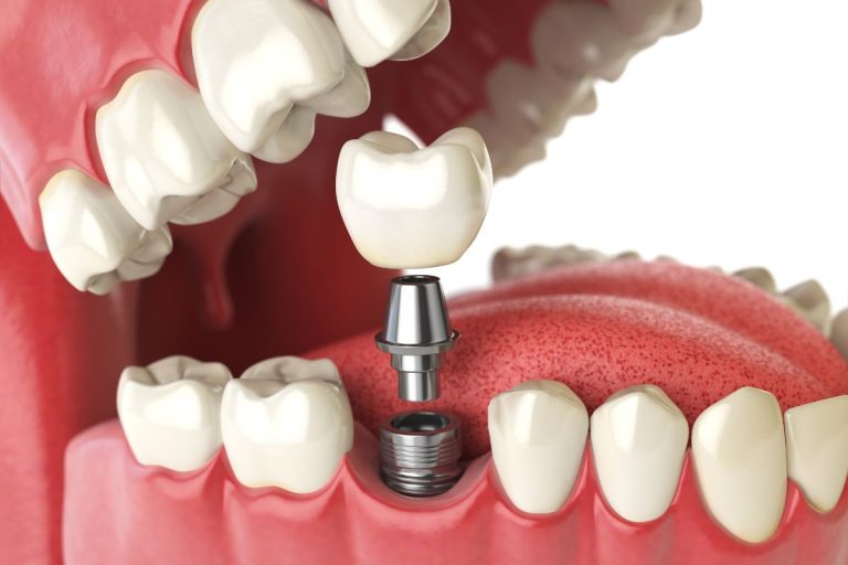 Alternatywy dla implantu: co zamiast implantu zęba?
