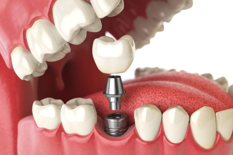 co zamiast implantu